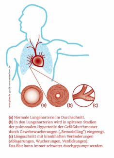 Lungenhochdruck  Trotz Warnzeichen nie an eine ernste Erkrankung gedacht