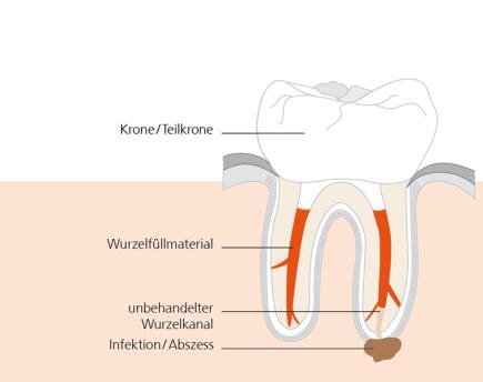Warum braucht ein Zahn manchmal eine erneute Wurzelkanalbehandlung?