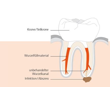 Warum braucht ein Zahn manchmal eine erneute Wurzelkanalbehandlung?