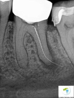 Was tun bei einem abgebrochenen Wurzelkanalinstrument im Zahn?