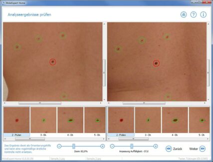 Hautkrebsvorsorge zuhause – Software findet veränderte Muttermale