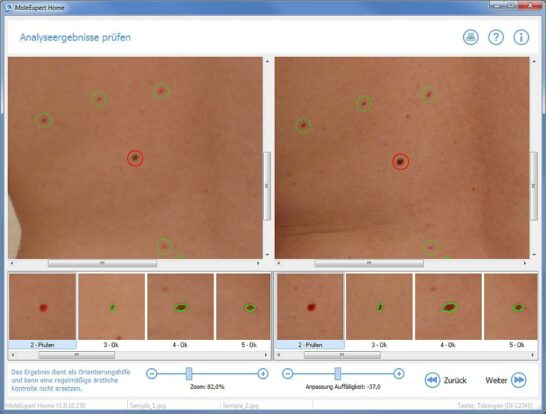 Hautkrebsvorsorge zuhause – Software findet veränderte Muttermale