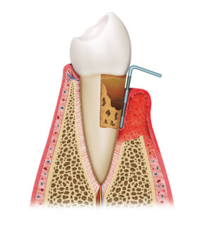 Emdogain® in der Parodontologie: Rettung für die Zähne bei Parodontitis