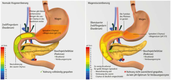 Niedriger pH im Duodenum und unzureichende Chymus-Durchmischung beeinflussen die Enzymsubstitutionstherapie