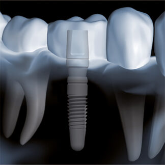 Investoren für patentiertes Zahnimplantat gesucht:Patienten profitieren von verbesserter Zahnfleischgesundheit