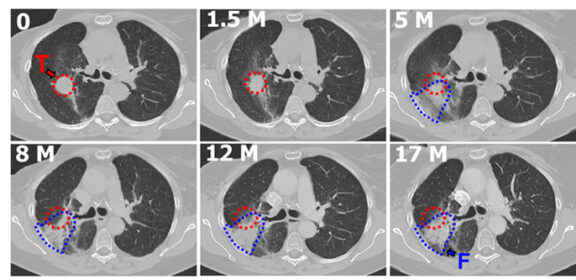 Antikörper wirkt gegen strahlenbedingte Lungenfibrose