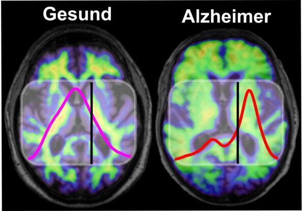 Bluttest zeigt früh das Alzheimer-Risiko an