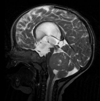 Genetisches Routinescreening für bestimmte kindliche Hirntumoren bald Standard?