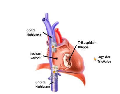 Klinikum Bielefeld: Neuartige Katheter-Herzklappe erstmalig in Nordrhein Westfalen implantiert