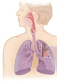 COPD – Chronische Lungenerkrankung mit guten Präventionsmöglichkeiten