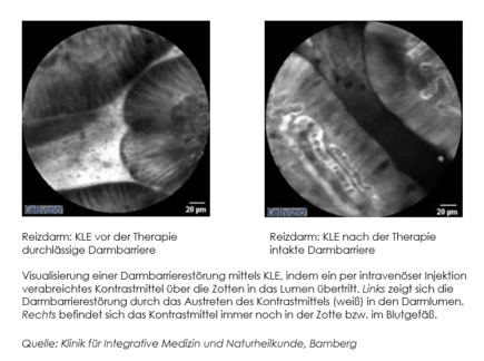 DGIM 2024: Neue Beobachtungsstudien zu RDS und CED zeigen:Myrrhe-Phytopharmakon kann Symptome wie Diarrhoe lindern
