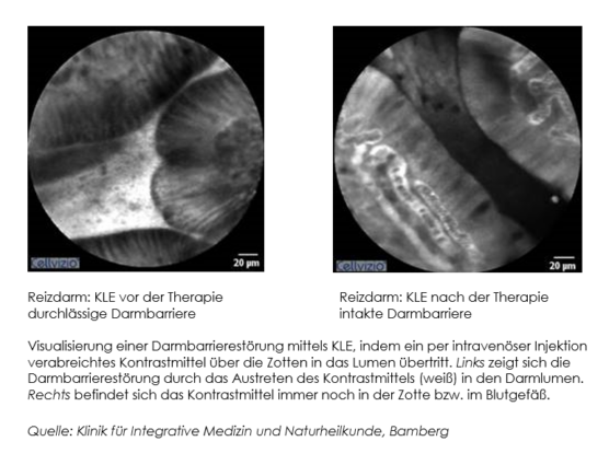 DGIM 2024: Neue Beobachtungsstudien zu RDS und CED zeigen:Myrrhe-Phytopharmakon kann Symptome wie Diarrhoe lindern