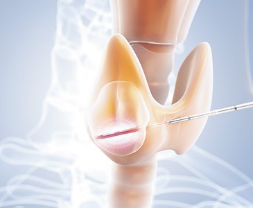 Betriebskrankenkassen übernehmen neue ambulante Behandlungsmethode bei Schilddrüsenknoten